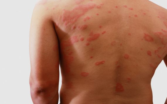 An Alternative to Traditional Shingles Pain Treatment in Grove, UT