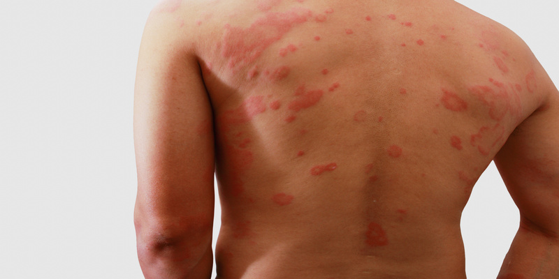 An Alternative to Traditional Shingles Pain Treatment in Grove, UT